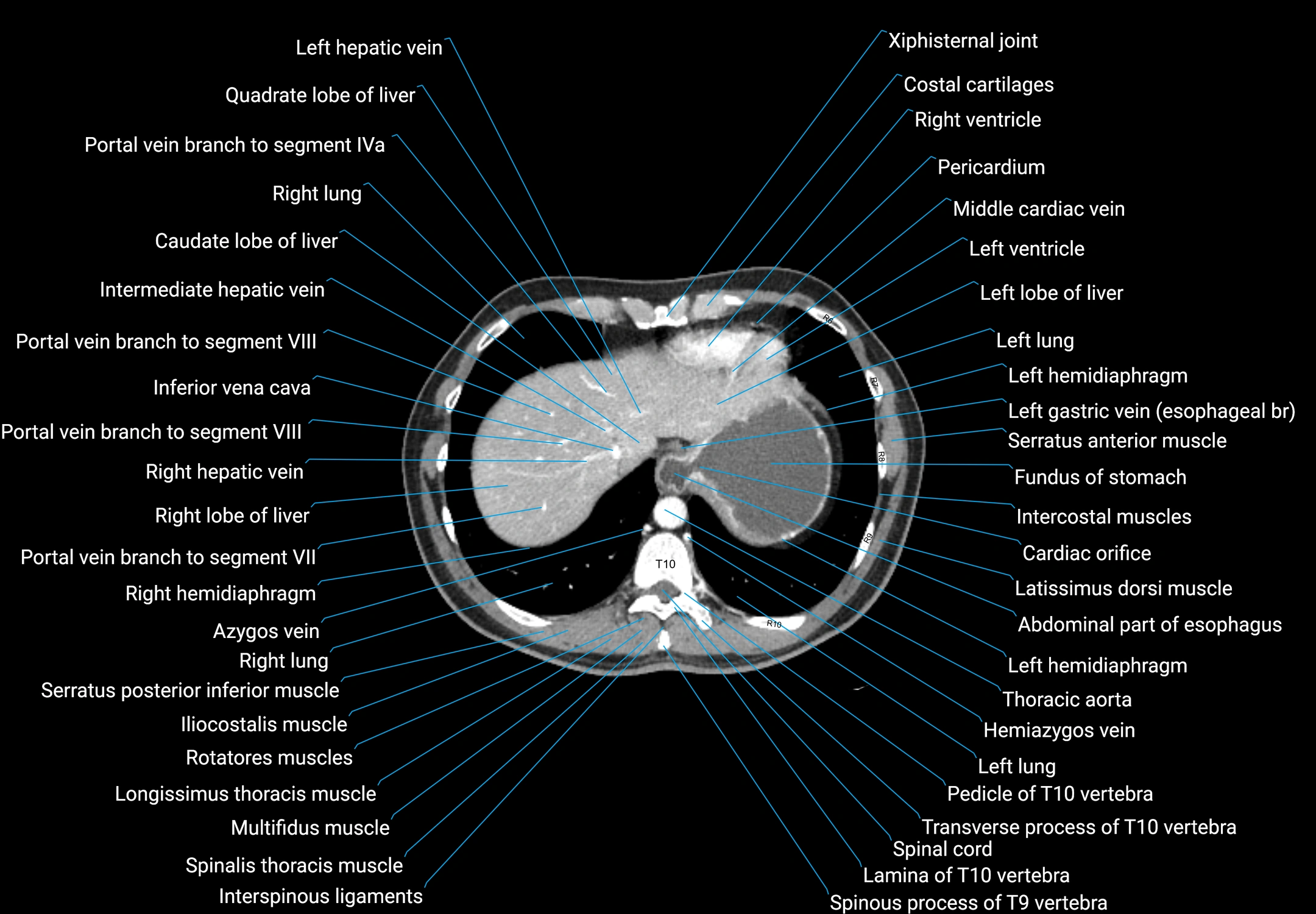 CT male pelvis axial cross sectional anatomy labelled radiology image -00016.webp
